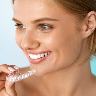 7 Benefits of Clear Braces