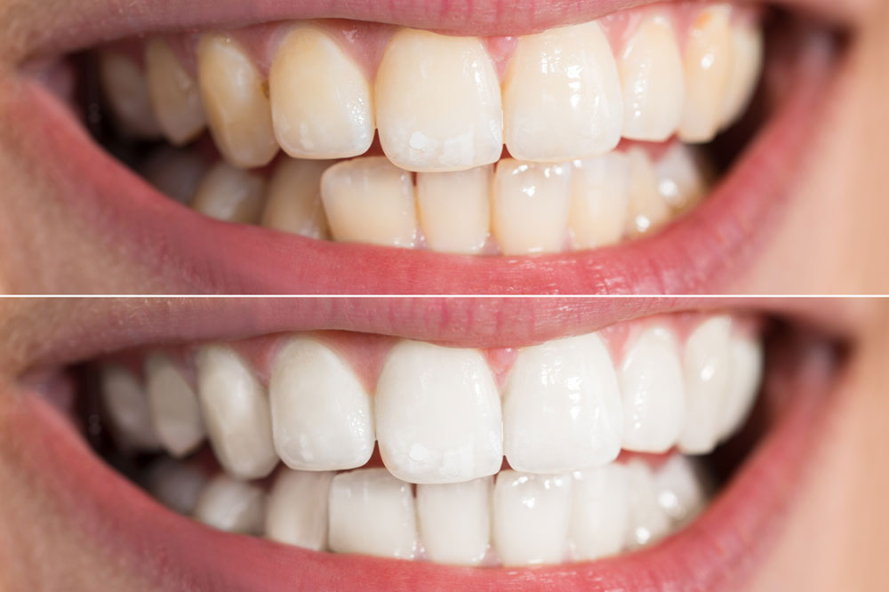 8 Natural Ways to Whiten Teeth at Home