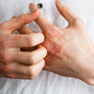 Common City Pollutants that Trigger Eczema and Allergies