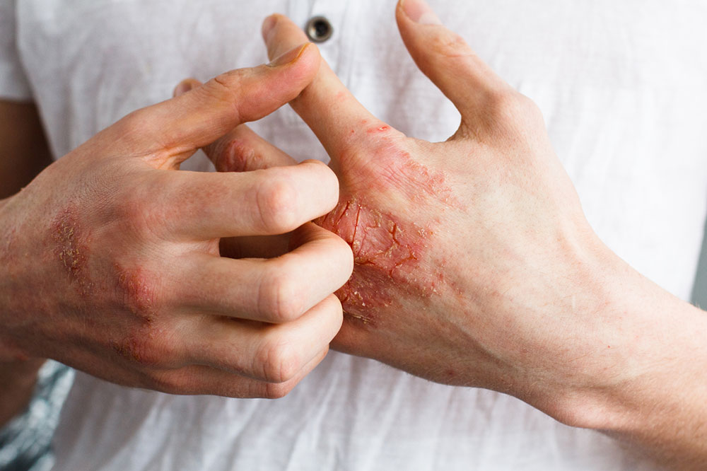 Common City Pollutants that Trigger Eczema and Allergies