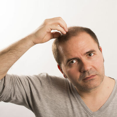 Effective Home Remedies to Manage Male Pattern Baldness