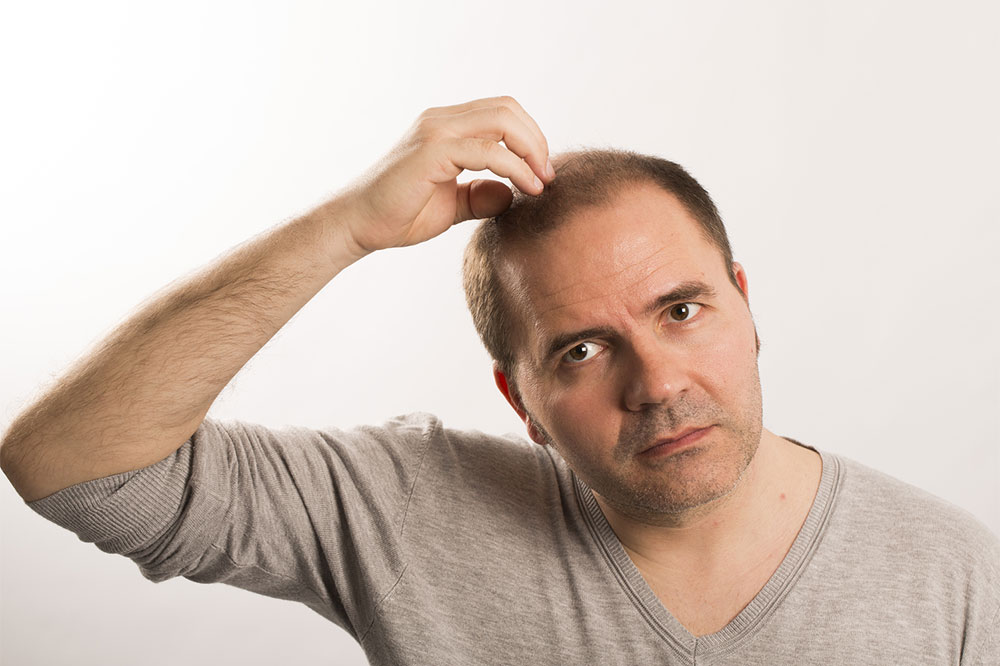 Effective Home Remedies to Manage Male Pattern Baldness