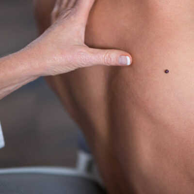 Signs and Symptoms of Melanoma Never to Ignore