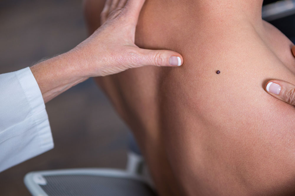 Signs and Symptoms of Melanoma Never to Ignore