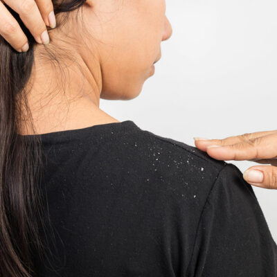 Top Tips for Preventing Dandruff and Flakes