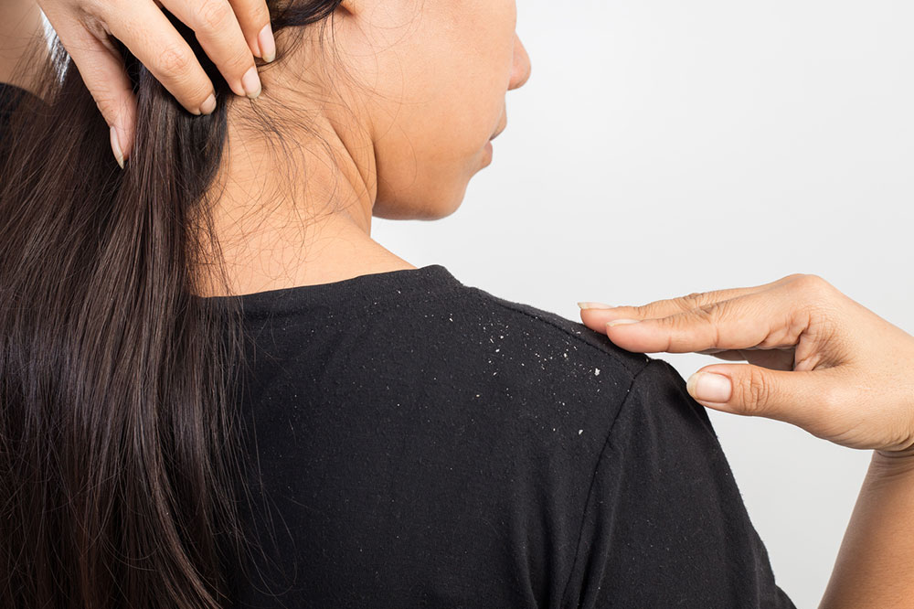 Top Tips for Preventing Dandruff and Flakes